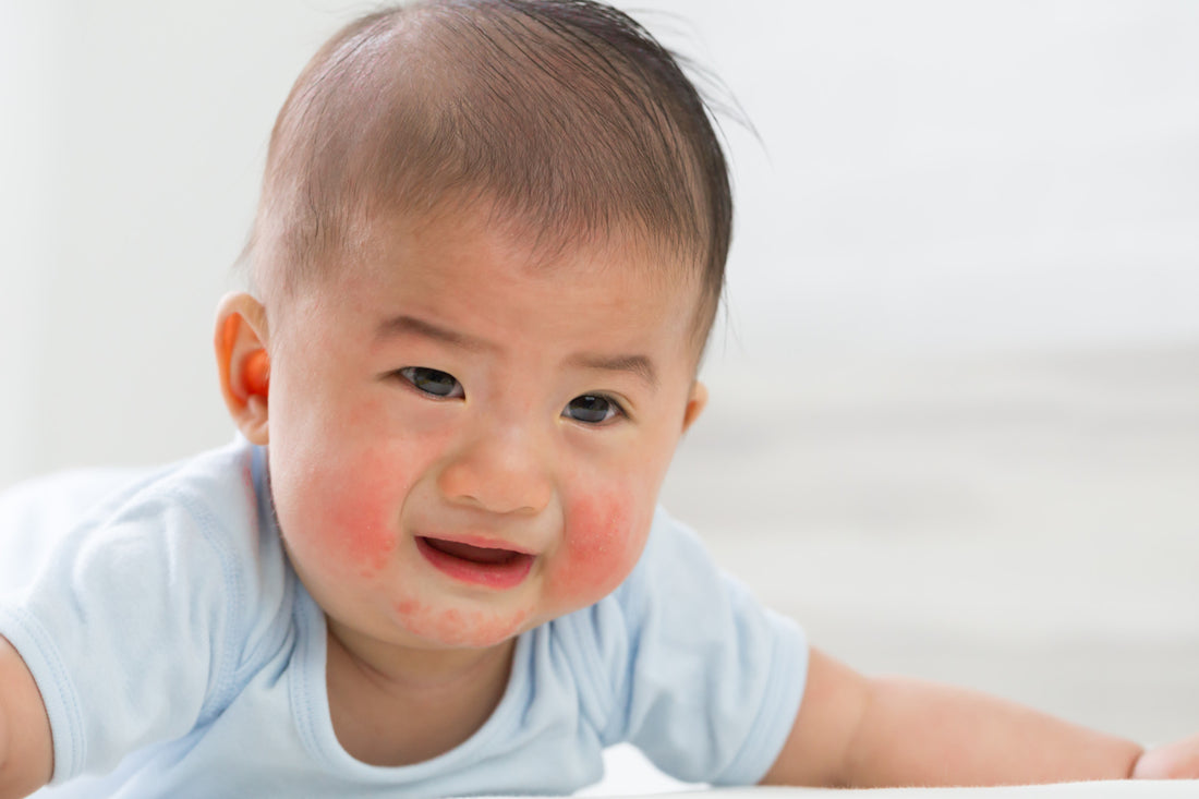 What can I do when my baby gets eczema?